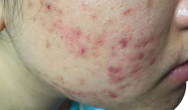 Acne Vulgaris