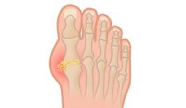 gout
