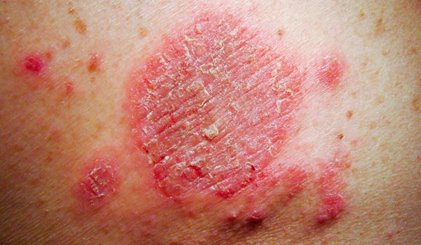 discoid eczema