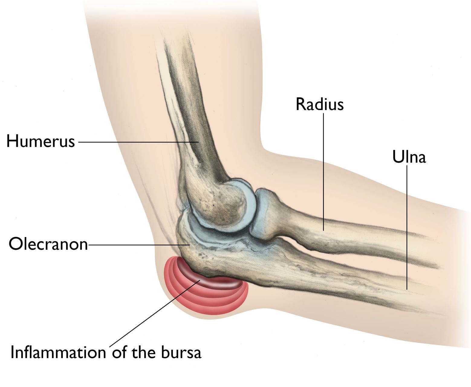 elbow bursitis