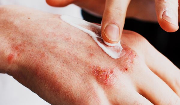 contact dermatitis